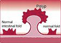 fig. 1Polipi del colon